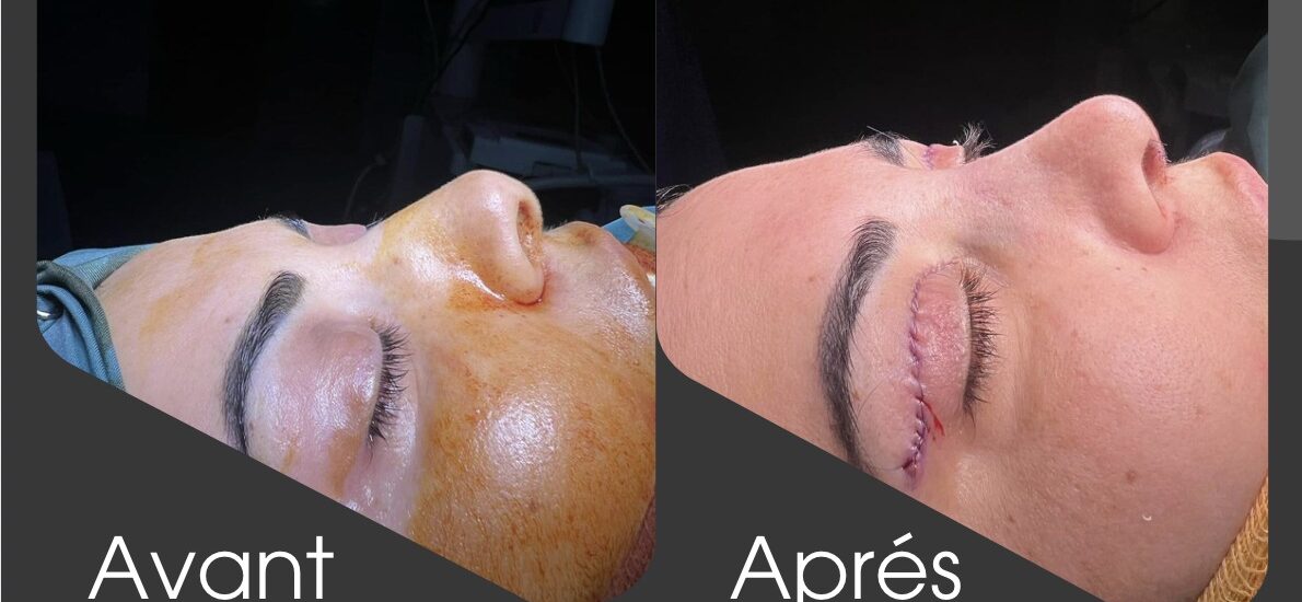 Blépharoplastie Tunisie