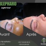 Blépharoplastie Tunisie
