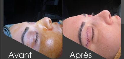 Blépharoplastie Tunisie