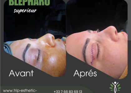 Blépharoplastie Tunisie