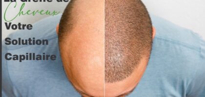 greffe cheveux tunisie