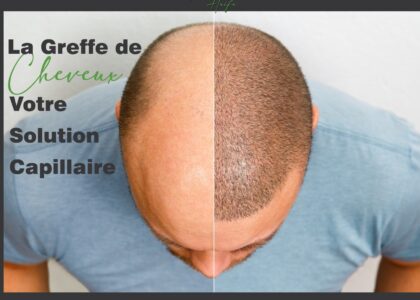 greffe cheveux tunisie