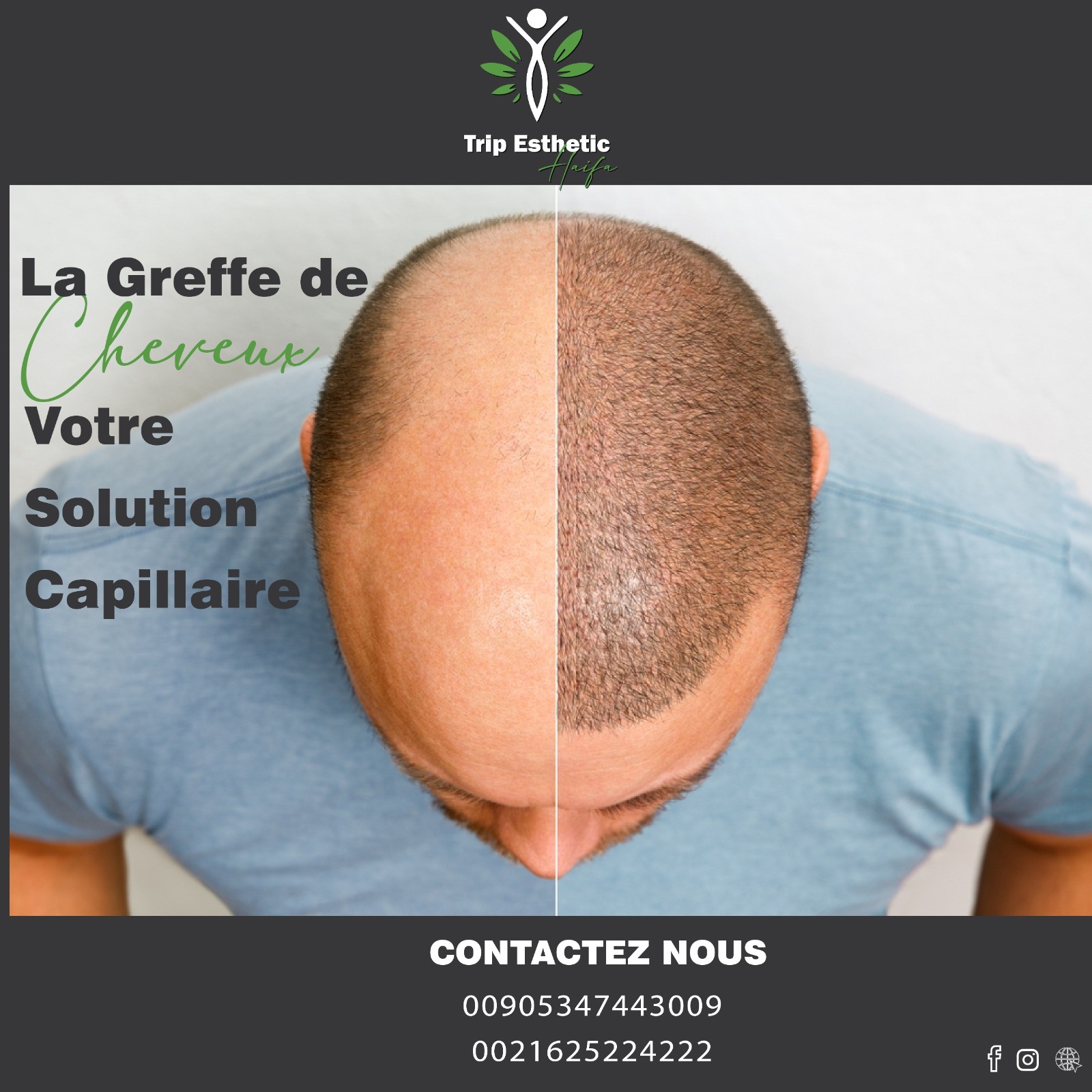 greffe cheveux tunisie
