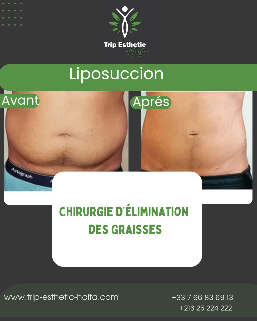 intervention de liposuccion en Tunisie avant/après
