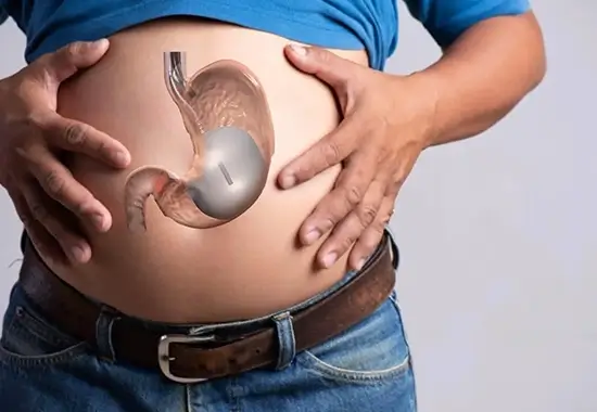 Schéma du ballon gastrique en polyuréthane en Tunisie chez Trip Esthetic Haïfa