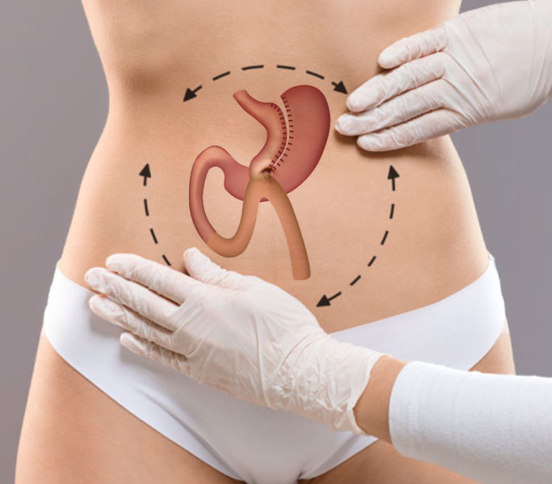 Schéma du bypass gastrique en Tunisie chez Trip Esthetic Haïfa
