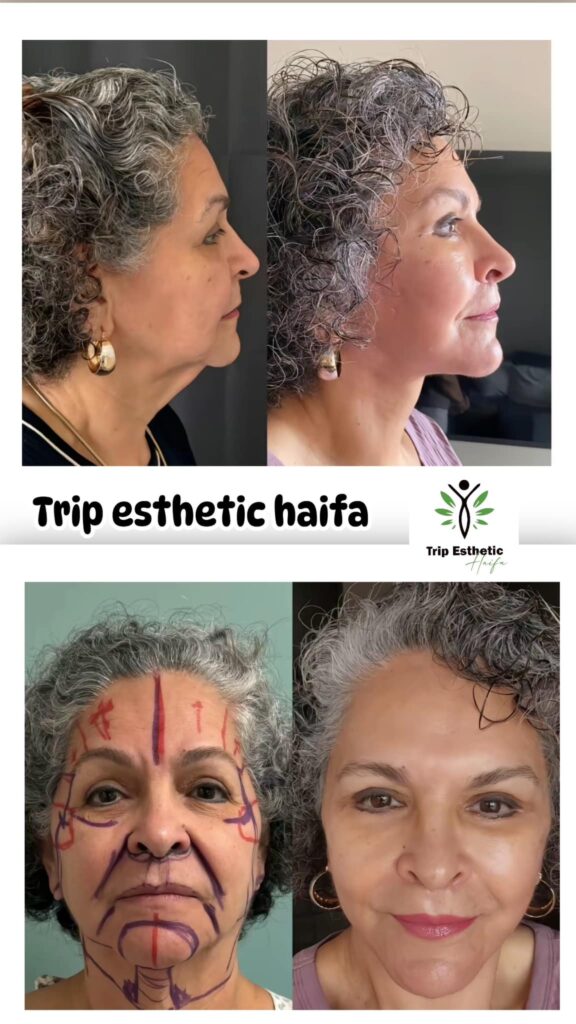 Lifting du Visage en Tunisie