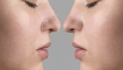 Rhinoplastie Secondaire