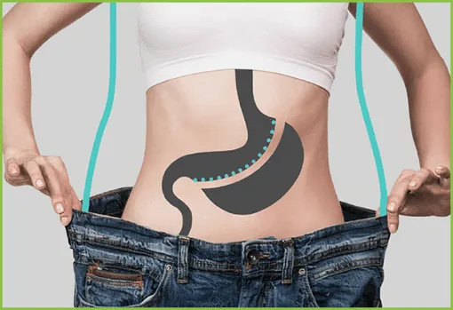 Schéma de la sleeve gastrique en Tunisie chez Trip Esthetic Haïfa