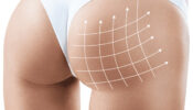 BBL – Brazilian Butt Lift