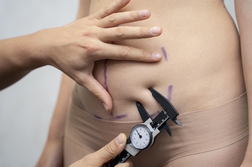Liposuccion en Tunisie chez Trip Esthetic Haïfa