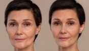 Lipofilling du Visage