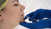 Liposuccion du double menton 